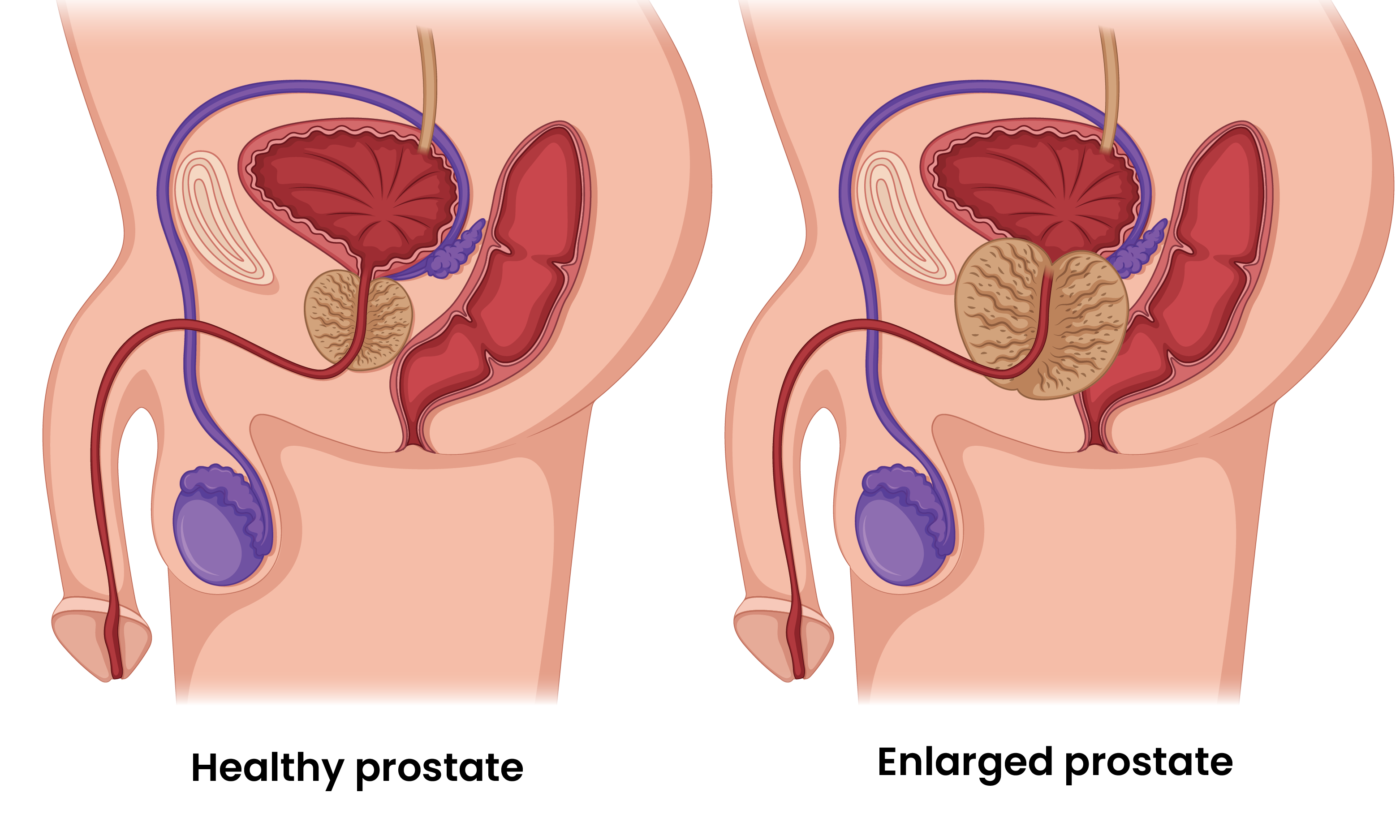 Prostate Treatment